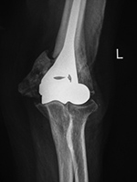 Elbow hemiarthroplasty