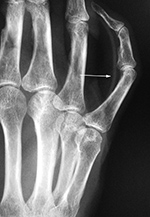 Flexor digitorum tendon reconstruction