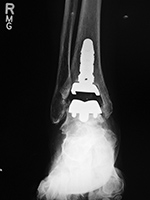 INBONE II total ankle replacement