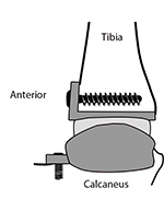 INTEGRA total ankle replacement lateral view
