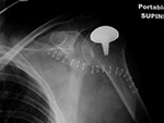 Shoulder resurfacing hemiarthroplasty