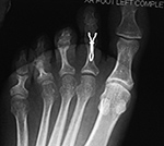 Smart toe implant