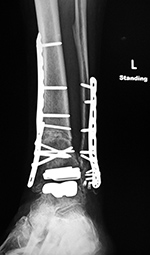 Zimmer trabecular metal total ankle prosthesis