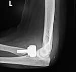 Left radial head prosthesis