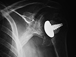 Left humeral head hemi-cap