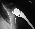 Left shoulder reverse total shoulder arthroplasty
