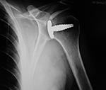 Left shoulder Hemi-CAP prosthesis