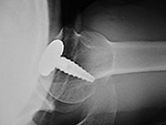 Left shoulder Hemi-CAP prosthesis
