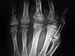 NeuFlex MCP joint implant system