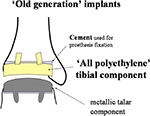 Old generation ankle implant