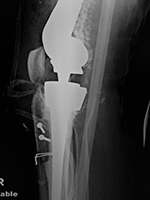Right knee revision implant