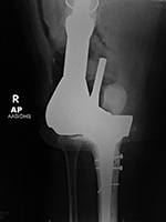 Right knee revision implant failure
