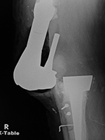 Right knee revision implant failure