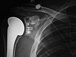 Right shoulder total arthroplasty