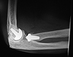 Left elbow radiocapitellar arthroplasty