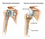 Shoulder arthroplasty