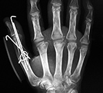 Silastic joint implants