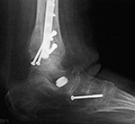 Sinus tarsi interference screw