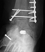 Sinus tarsi interference screw