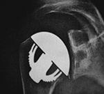 TESS shoulder replacement system