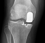 Unicompartmental knee prosthesis