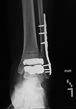 Total ankle prosthesis